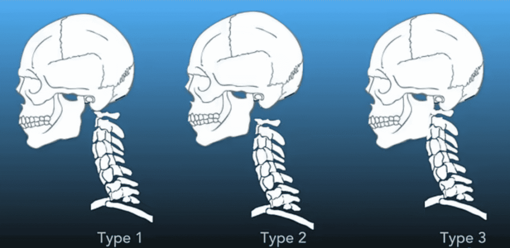 Chirurgie de la jonction occipito-cervicale : techniques modernes