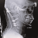 décapitation interne, atlanto-occipital dislocation,