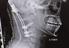 décapitation interne, atlanto-occipital dislocation,