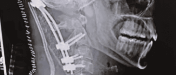 décapitation interne, atlanto-occipital dislocation,