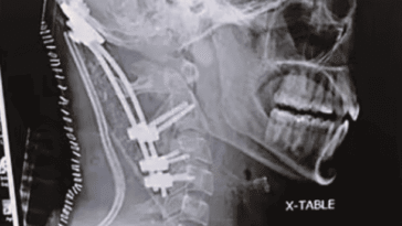 décapitation interne, atlanto-occipital dislocation,