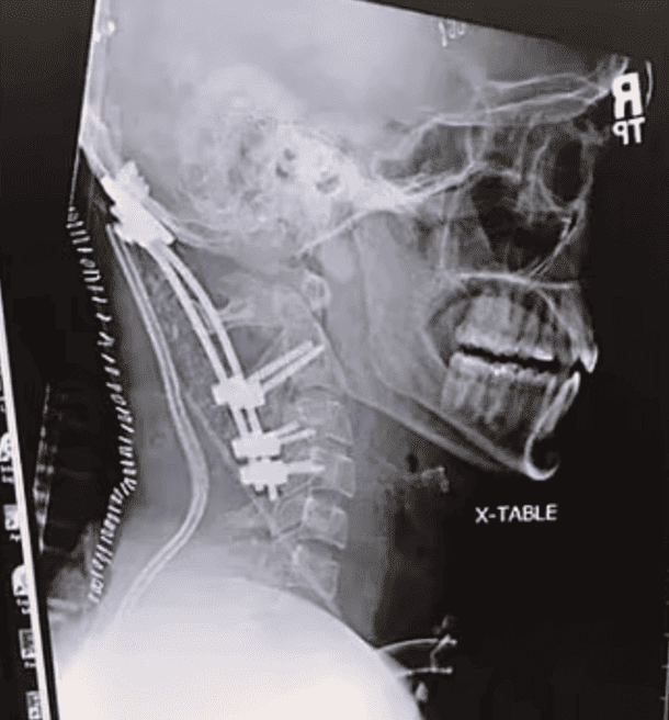décapitation interne, atlanto-occipital dislocation,